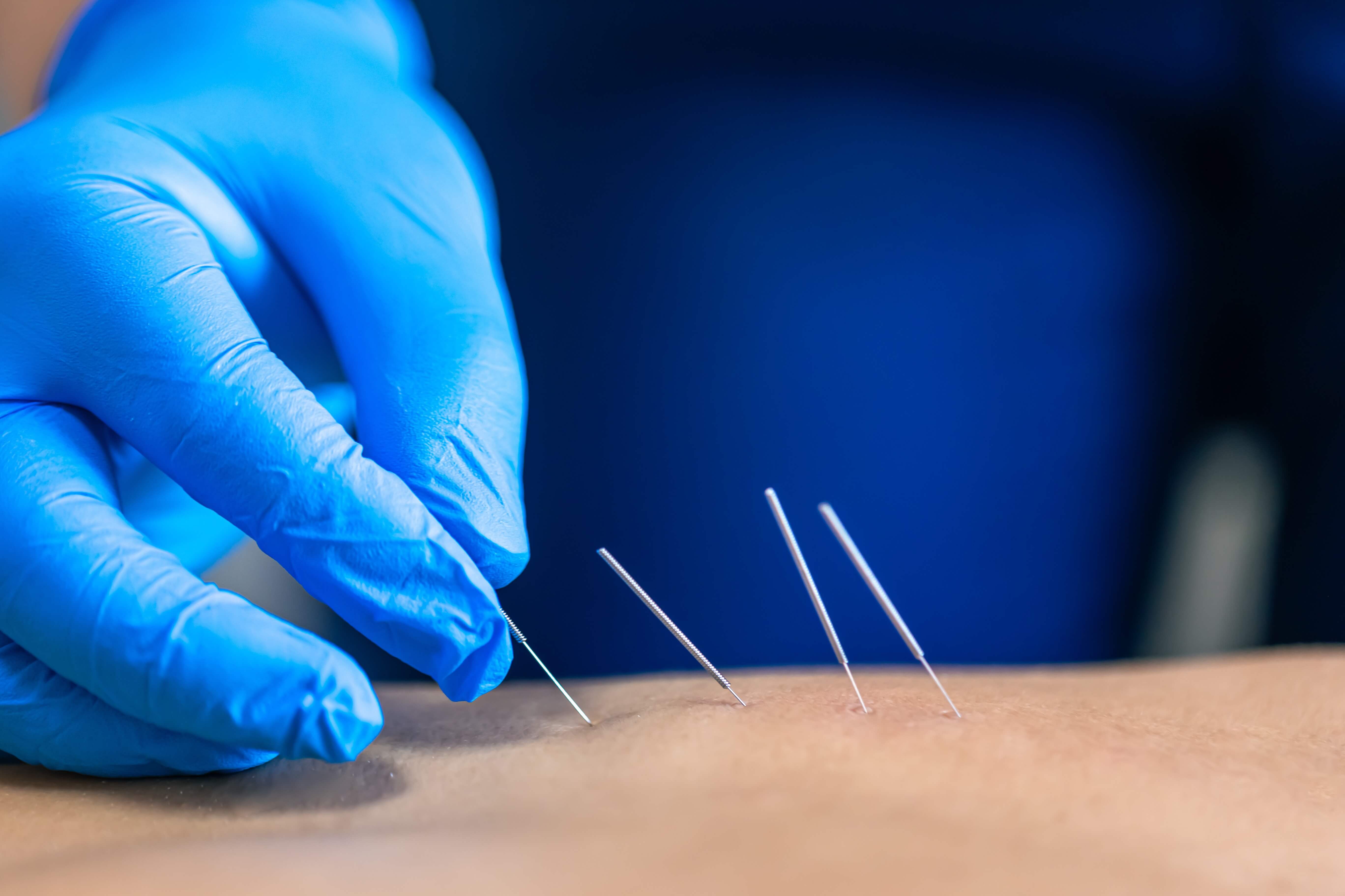 Dry needling therapy session