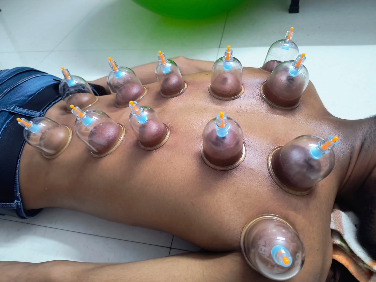 Hijama cupping therapy treatment